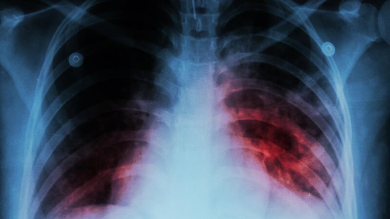 Advierten sobre un grave aumento de los casos de tuberculosis