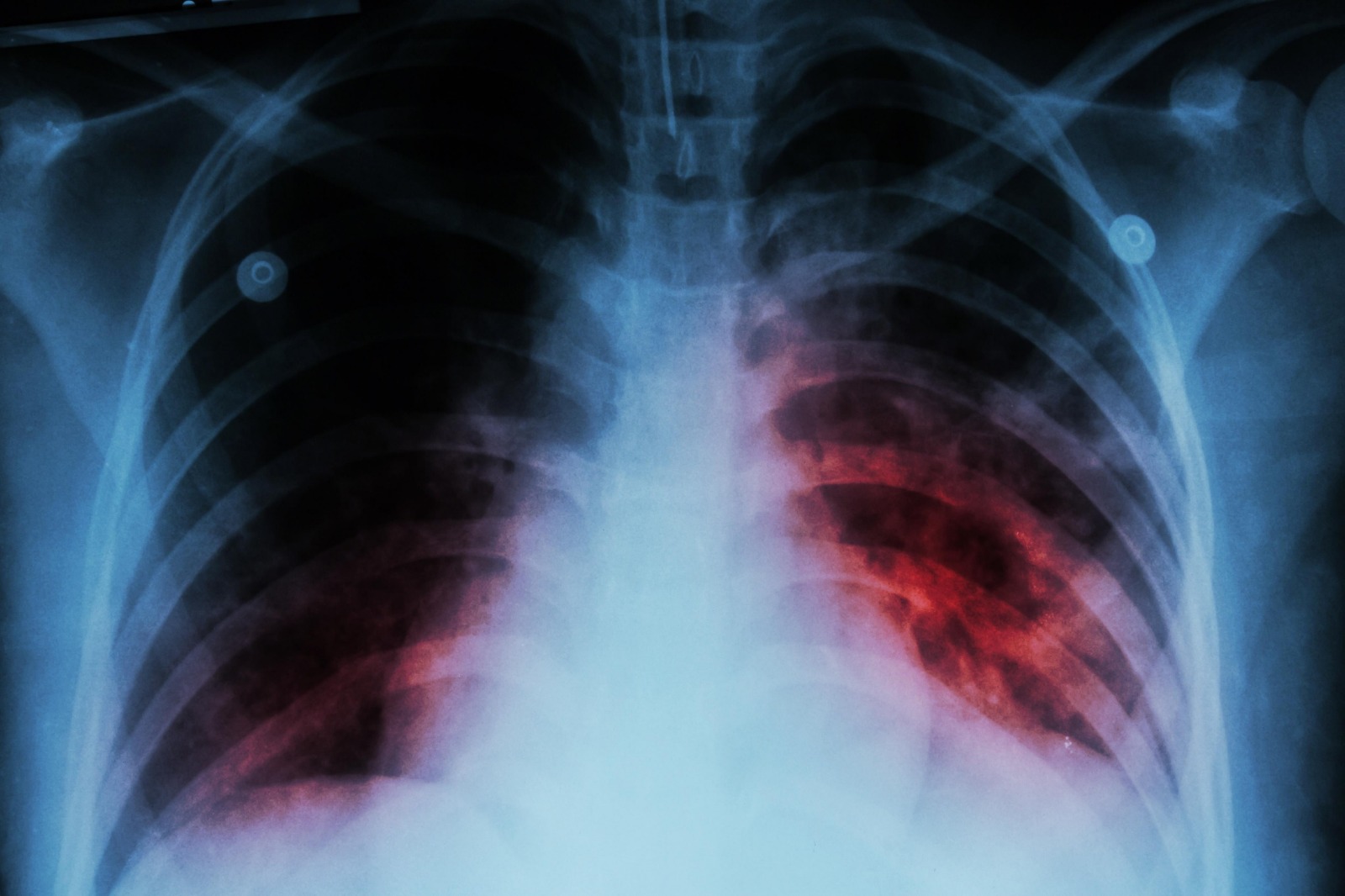 Advierten sobre un grave aumento de los casos de tuberculosis